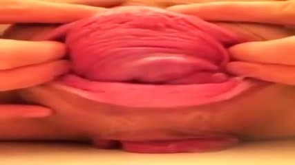 prolapsing both holes